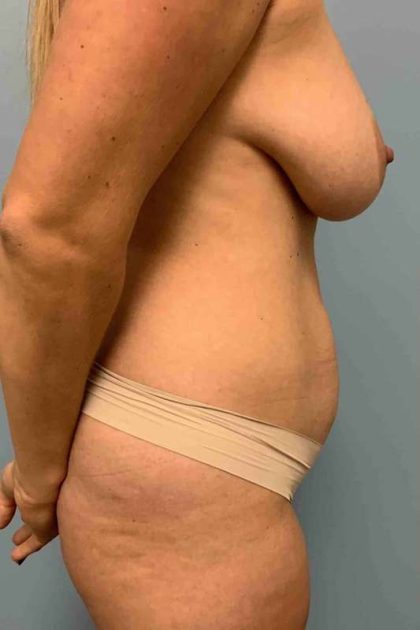 VASER Liposelection Before & After Patient #10584