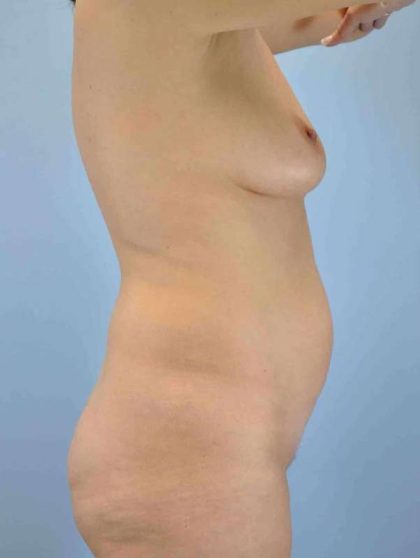 VASER Liposelection Before & After Patient #10593