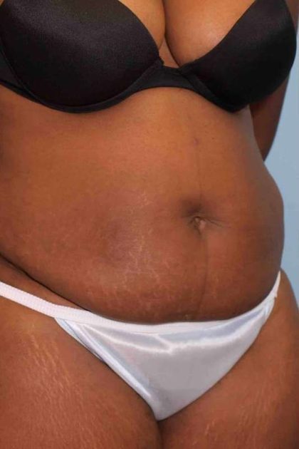 VASER Liposelection Before & After Patient #10631