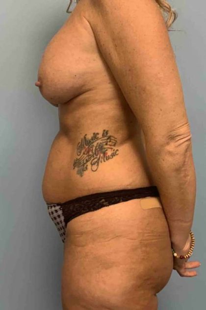 VASER Liposelection Before & After Patient #10643