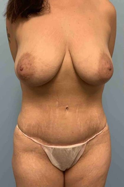 VASER Liposelection Before & After Patient #10661