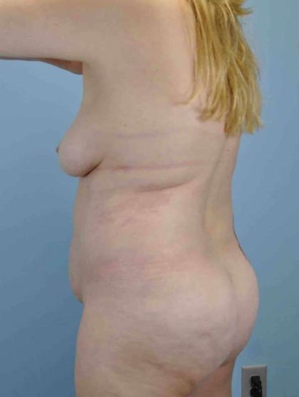 Tummy Tuck Before & After Patient #10714