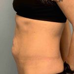 Tummy Tuck Before & After Patient #10721