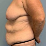 Tummy Tuck Before & After Patient #10728