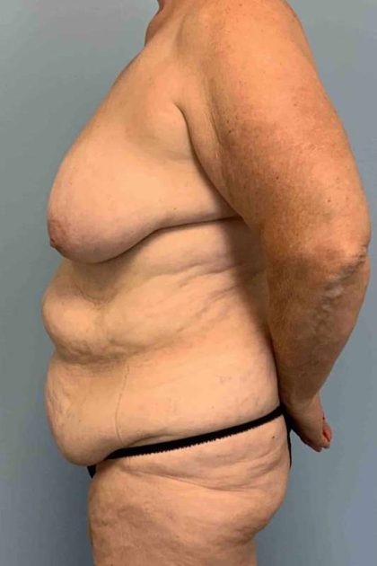 Tummy Tuck Before & After Patient #10728