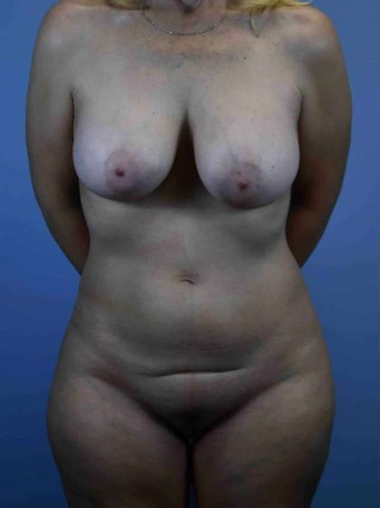 Tummy Tuck Before & After Patient #10733