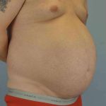 Tummy Tuck Before & After Patient #10749
