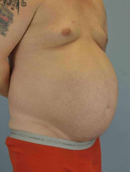 Tummy Tuck Before & After Patient #10749