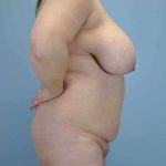 Tummy Tuck Before & After Patient #10765