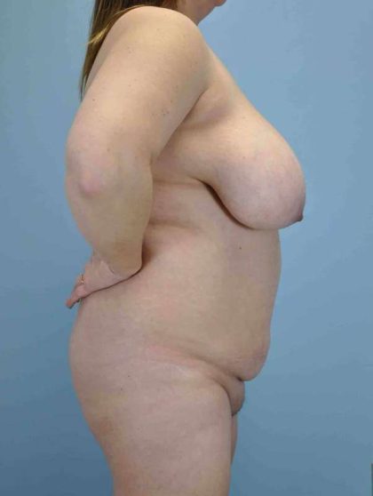 Tummy Tuck Before & After Patient #10765