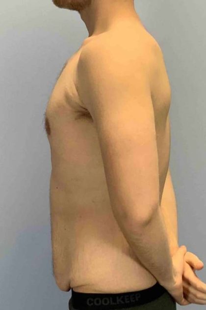 Tummy Tuck Before & After Patient #10832
