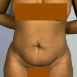 Tummy Tuck Before & After Patient #10839