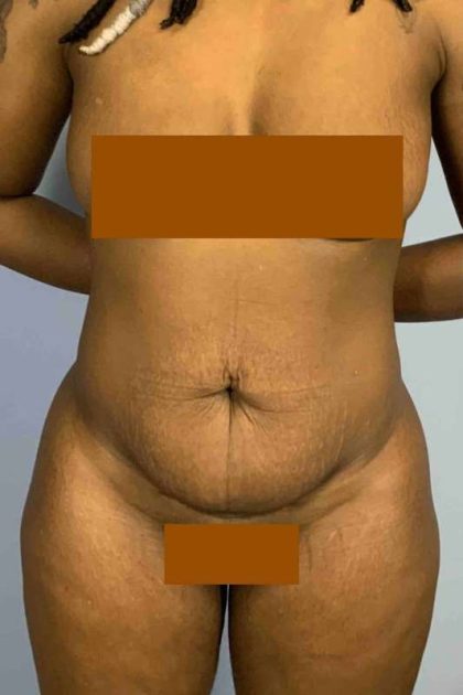 Tummy Tuck Before & After Patient #10839