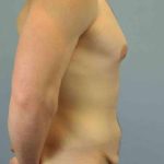 Tummy Tuck Before & After Patient #10846