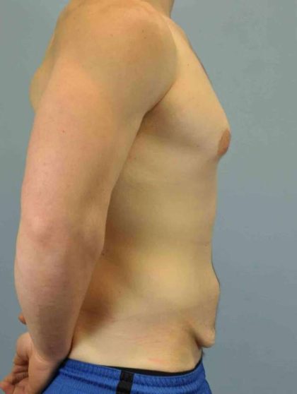 Tummy Tuck Before & After Patient #10846
