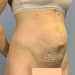 Tummy Tuck Before & After Patient #10862