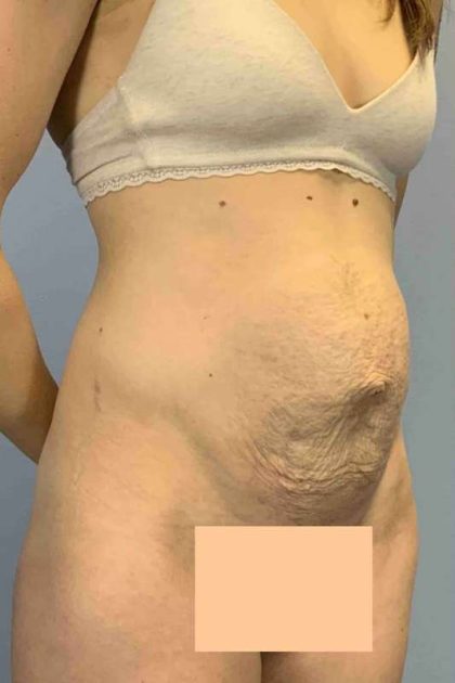 Tummy Tuck Before & After Patient #10862
