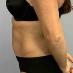 Tummy Tuck Before & After Patient #10869