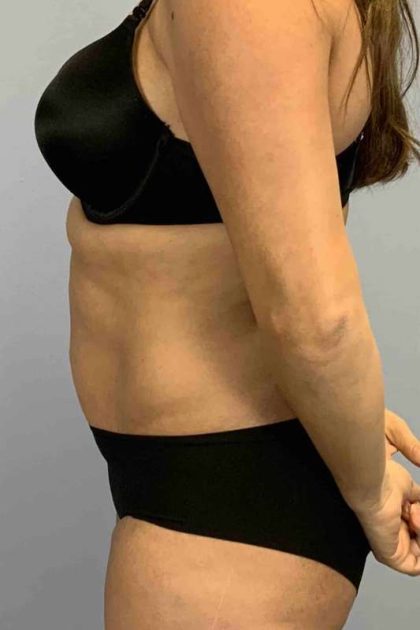 Tummy Tuck Before & After Patient #10869