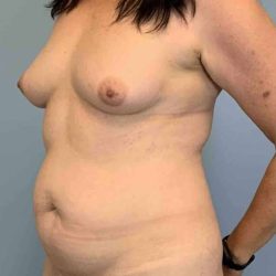 Tummy Tuck Before & After Patient #10874