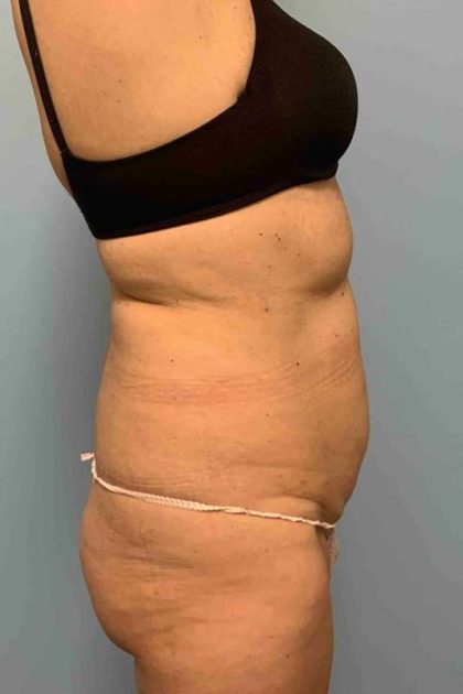 Tummy Tuck Before & After Patient #10881