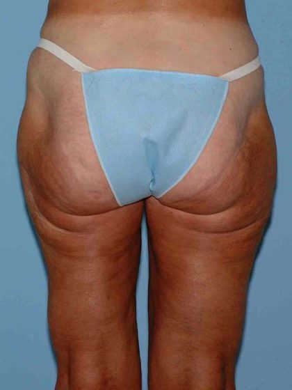Thigh Surgery Before & After Patient #10890