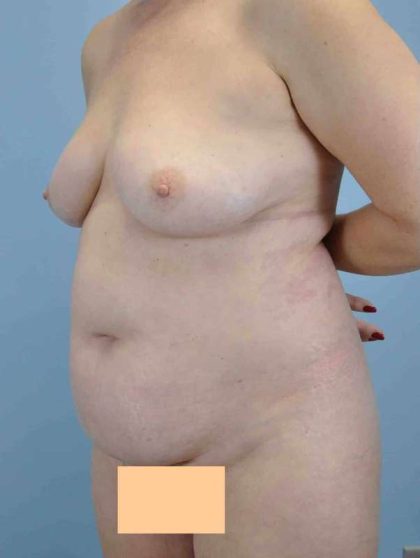 VASER Liposelection Before & After Patient #10384