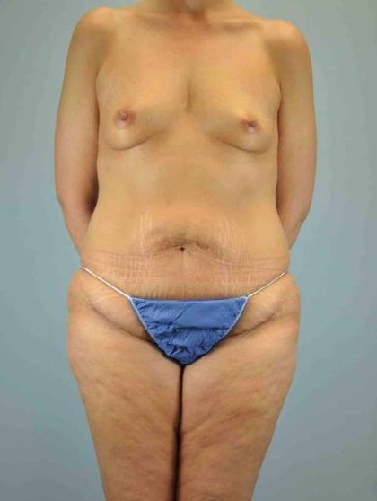 Thigh Surgery Before & After Patient #10900