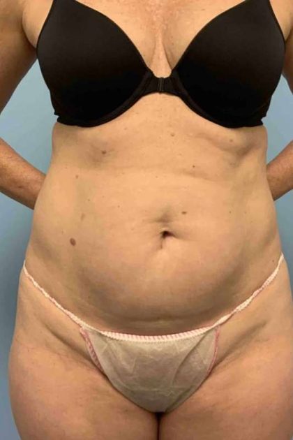 Renuvion Before & After Patient #10921