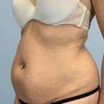 Renuvion Before & After Patient #10935