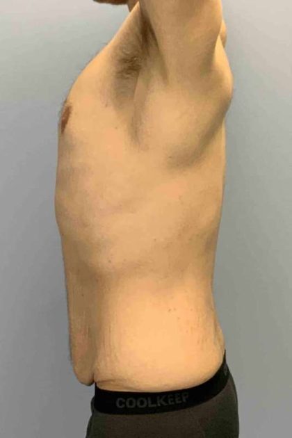 Renuvion Before & After Patient #10944