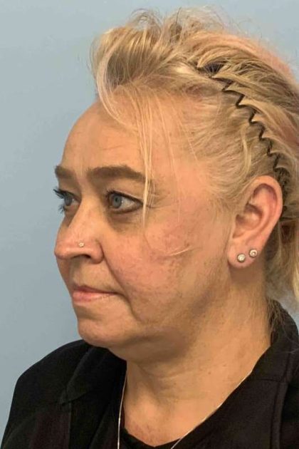 Renuvion Before & After Patient #10951