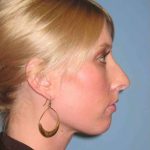 Nose Surgery Before & After Patient #10990