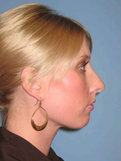 Nose Surgery Before & After Patient #10990