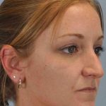 Nose Surgery Before & After Patient #10997