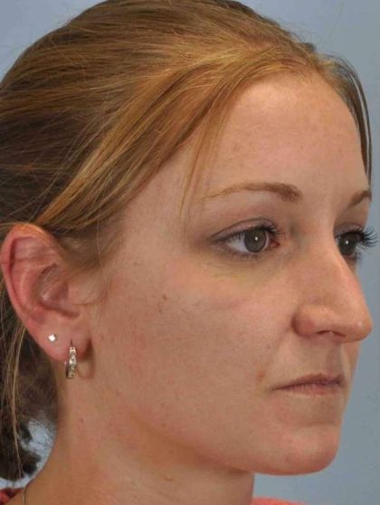 Nose Surgery Before & After Patient #10997