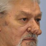 Nose Surgery Before & After Patient #11011