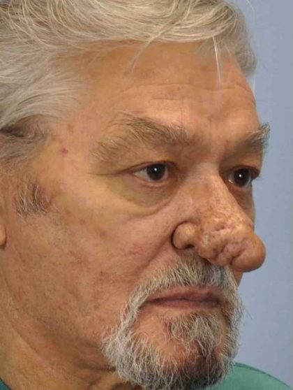 Nose Surgery Before & After Patient #11011