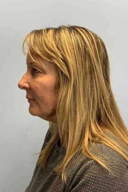 Nose Surgery Before & After Patient #11018