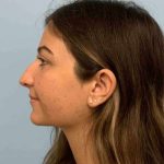 Nose Surgery Before & After Patient #11025