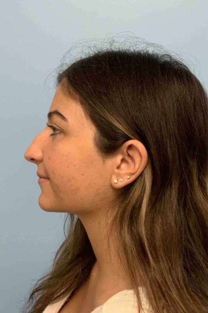 Nose Surgery Before & After Patient #11025