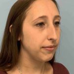 Nose Surgery Before & After Patient #11032