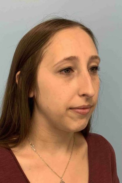 Nose Surgery Before & After Patient #11032