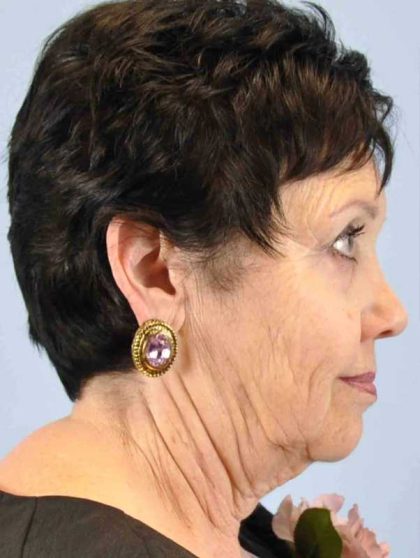 Neck Lift Before & After Patient #11039