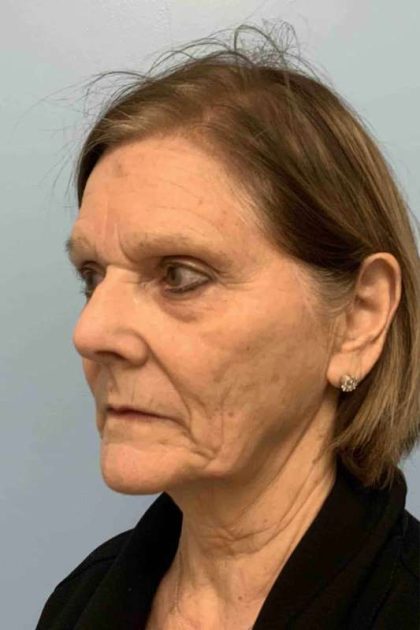 Neck Lift Before & After Patient #11053
