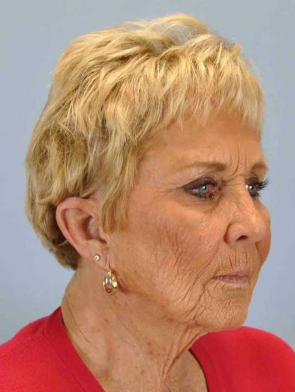 Neck Lift Before & After Patient #11069