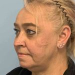 Neck Lift Before & After Patient #11083