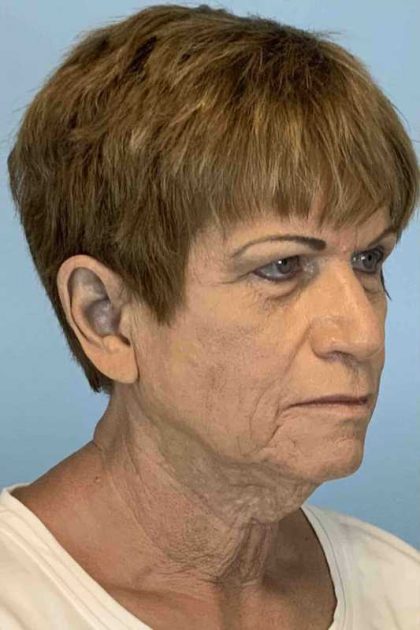 Neck Lift Before & After Patient #11092