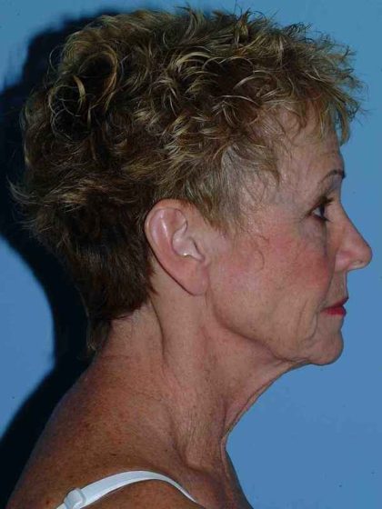 Neck Lift Before & After Patient #11111