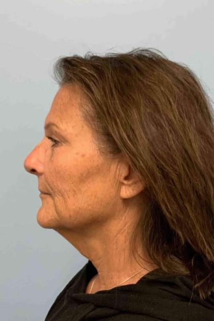 Neck Lift Before & After Patient #11134